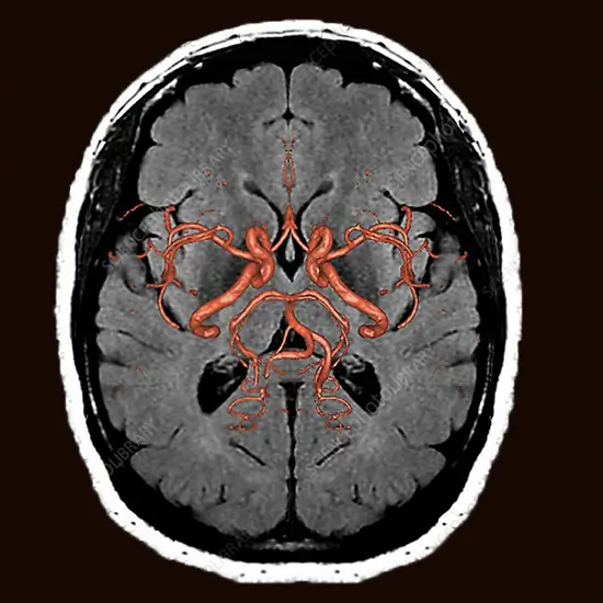 MRI Head & Stroke 3D